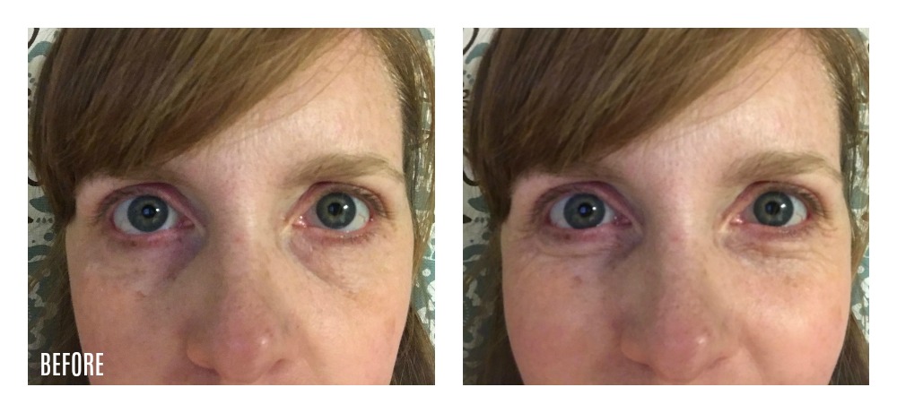 The Ordinary skin care review: Caffeine Solution 5% + EGCG before pictures